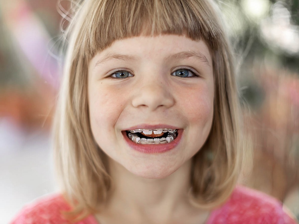 What Are the Benefits of Early Orthodontics?