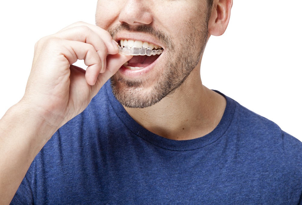 Clear Aligners Can Improve Your Smile